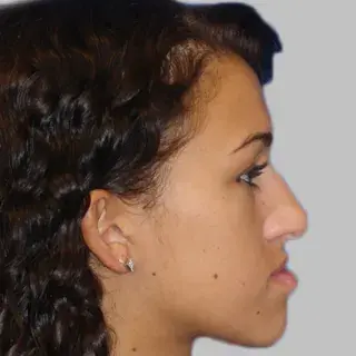 vsp orthognathics preop photo