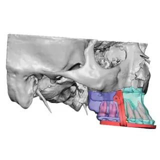 vsp segmental lefort guide right