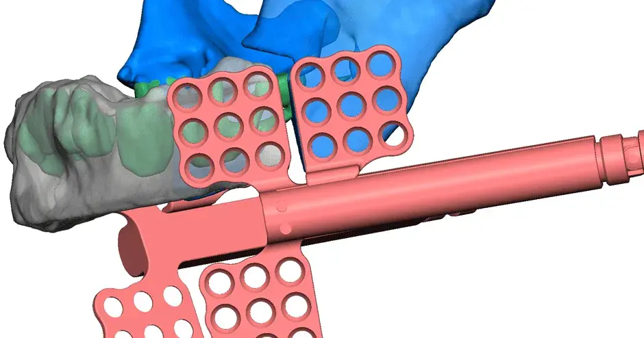 3D Systems VSP Distraction planning image left feature depth