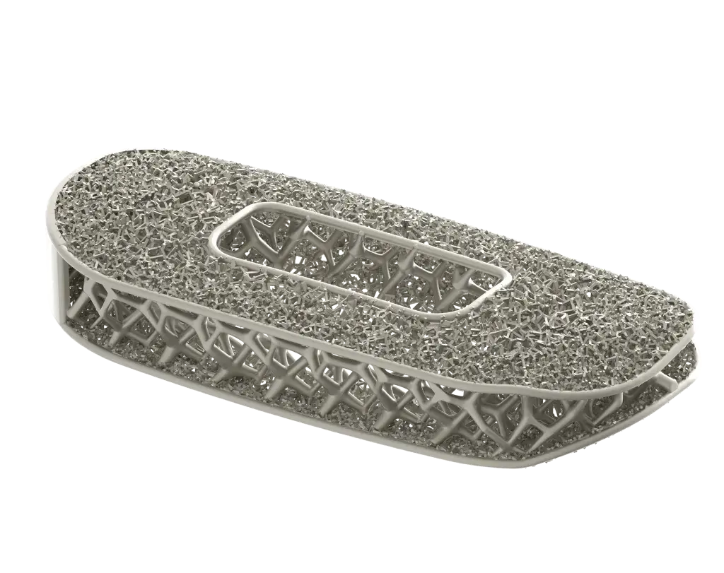 Optimiertes Wirbelsäulenimplantat von NuVasive, hergestellt im 3D-Druckverfahren