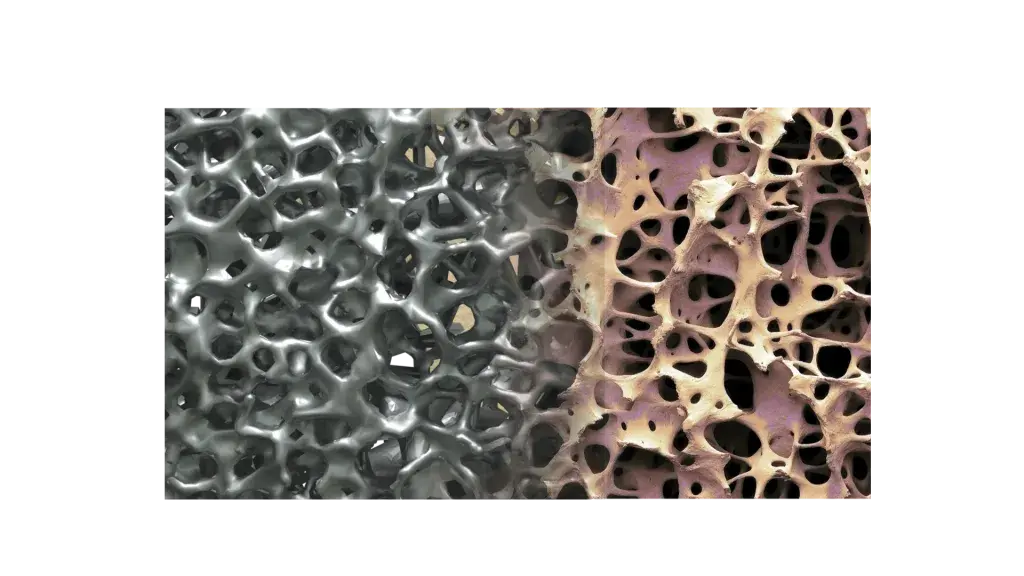 Das Design der Wirbelsäulenimplantate der Modulus-Reihe von NuVasive wurde entwickelt, um die klinischen Ergebnisse für Patienten mit Wirbelsäulenimplantaten zu verbessern.