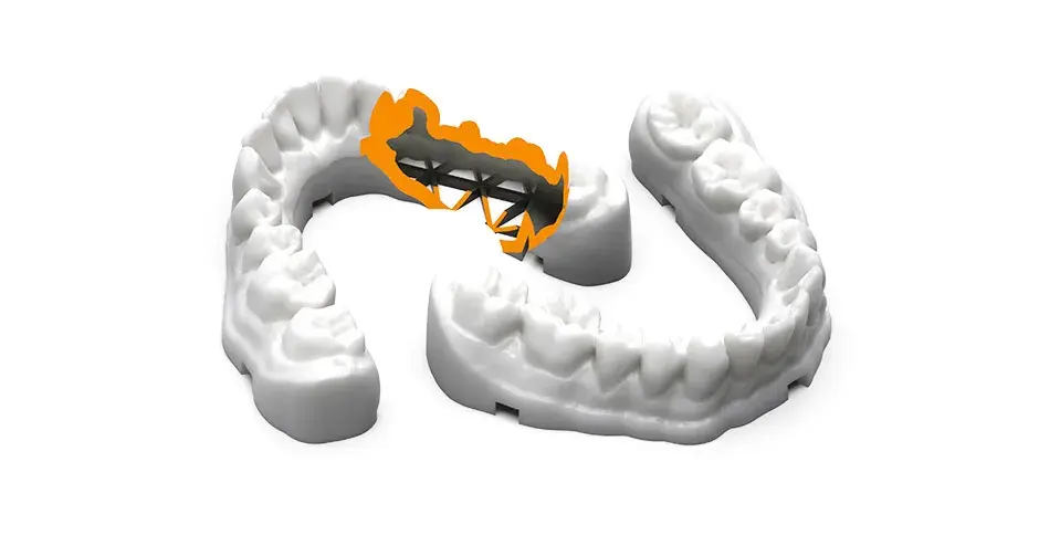 Dentalsteg mit 3D Sprint-Software aus TruShell-Material gedruckt