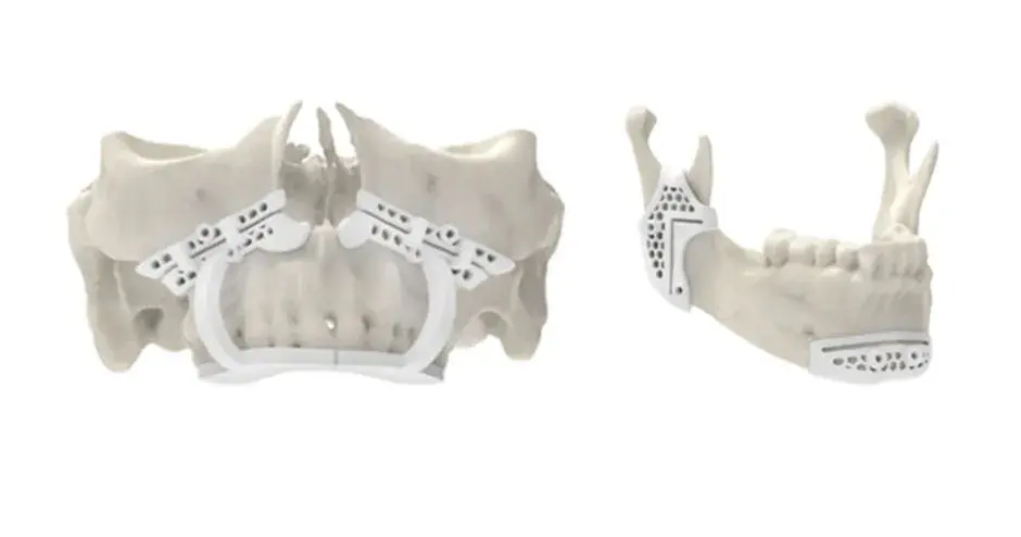 3D printed nylon guides for VSP CMF