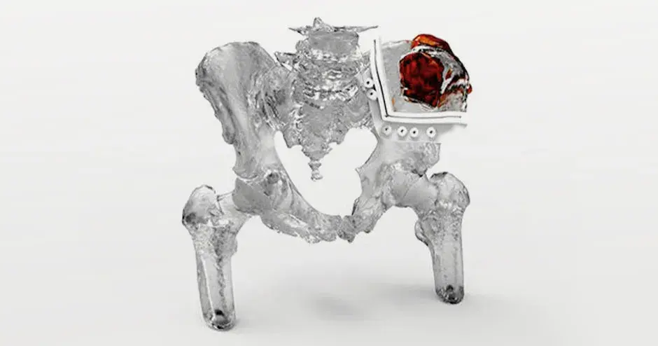 3D Systems’ FDA cleared VSP Orthopaedics solution enables surgeons to obtain a clear 3D visualization of a patient’s anatomy and develop a personalized surgical plan, prior to entering the operating room.