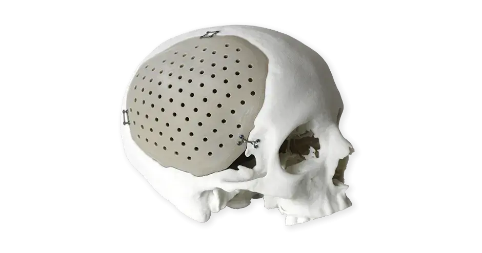 Kraniale Implantate aus PEEK