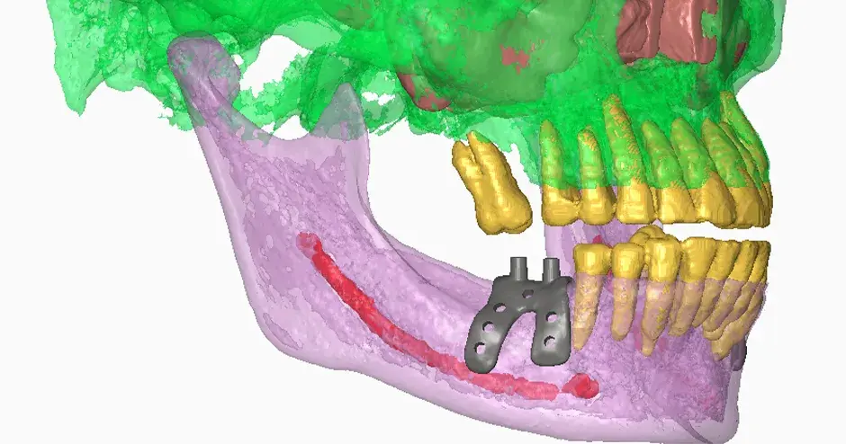Graft3D Dentalimplantate