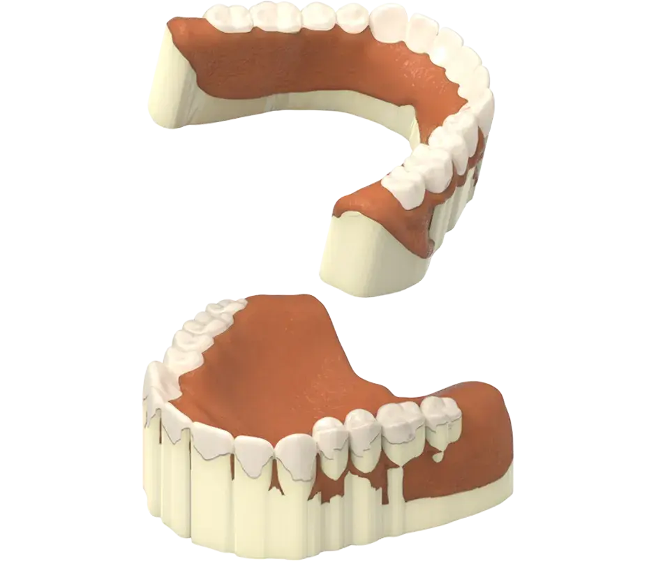 NextDent-Produktion Entfernen der Stützstrukturen