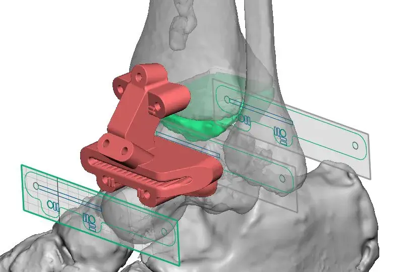 vantage ankle psi