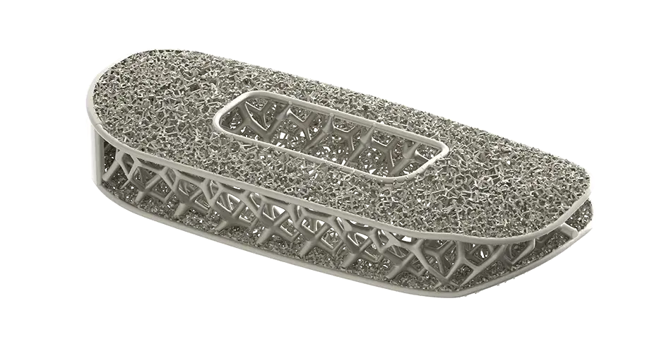 Optimiertes Wirbelsäulenimplantat von NuVasive, hergestellt im 3D-Druckverfahren 